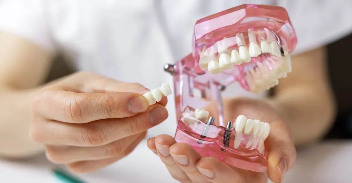 Dental Implants in San Jose: A Clear Guide to the Process